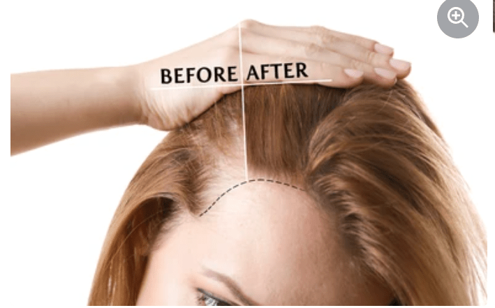 Hói đầu nữ: Biểu hiện, nguyên nhân và hướng điều trị hiệu quả